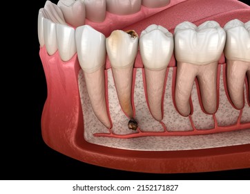 Periostitis Tooth - Lump On Gum Above Tooth. Dental Dental 3D Illustration