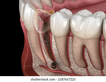 Periostitis Tooth - Lump On Gum Above Tooth. Dental 3D Illustration