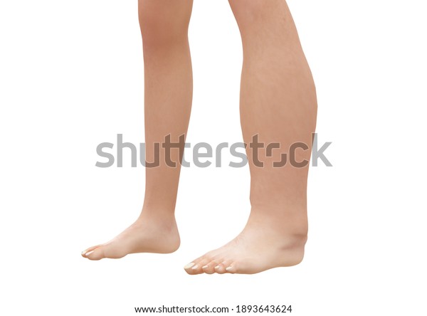 Peripheral Edema Swelling Legs Foot Ankle Stock Illustration 1893643624 9854