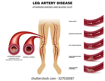 Peripheral Leg Arterial Disease And Healthy Artery. Atherosclerosis Progression And At The End Blood Clot.