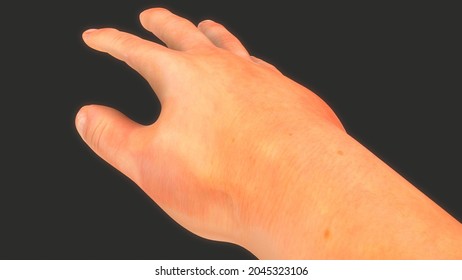 Pernicious Anemia Symptoms In Hand.3d Illustration