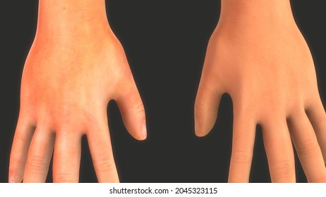 Pernicious Anemia Symptoms In Hand.3d Illustration