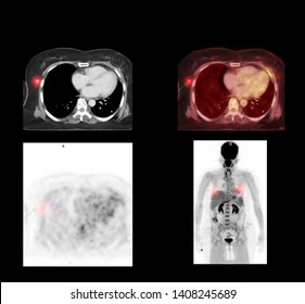 PET CT Scan Image Of Whole Body Comparison Axial Plane In CT Scan And PET CT For Detect Cancer Recurrence In Patient Lung Cancer Disease .