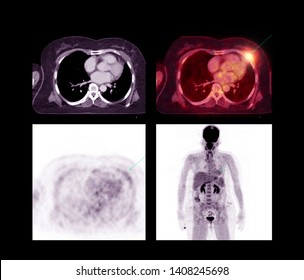 PET CT Scan Image Of Whole Body Comparison Axial Plane In CT Scan And PET CT On The Screen  For Detect Cancer Recurrence In Patient Lung Cancer Disease .