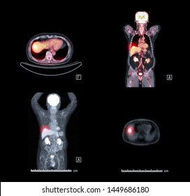 PET CT Scan Image Of Whole Body Comparison Axial ,Sagittal And  Plane For Detect Cancer Recurrence In Patient Cancer Disease .