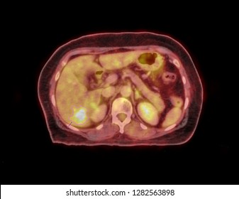 PET CT Scan For Liver Cancer Axial View.