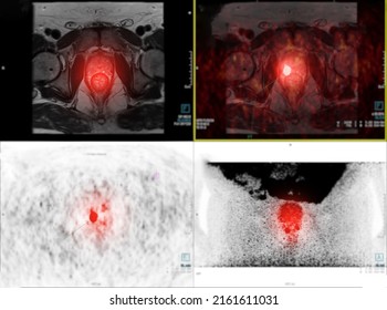 PET And MRI Prostate Gland  Fusion Imaging In High-grade Prostate Cancer.