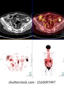 PET Scan Image Of Abdomen For Detect Lung Cancer Recurrence After Surgery. Medical Technology Concept.