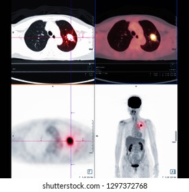 PET Scan Image Of The Chest Comparison Axial And Coronal Plane Showign Lung Cancer.