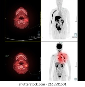 PET Scan Image Of Neck For Detect Lung Cancer Recurrence After Surgery. Medical Technology Concept.