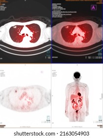 PET Scan Image Of Thorax Or Chest  Comparison Axial , Coronal  For Detect Lung Cancer Recurrence After Surgery. Medical Technology Concept.