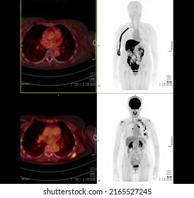 PET Scan Image Of Thorax Or Chest  Comparison Axial , Coronal  For Detect Lung Cancer Recurrence After Surgery. Medical Technology Concept.