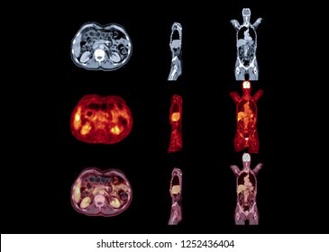 PET Scan Image Of Whole Body Comparison Axial , Coronal And Sagittal Plane For Detect Cancer Recurrence After Surgery. Medical Technology Concept.