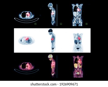 PET Scan Image Of Whole Body Comparison Axial , Coronal And Sagittal Plane For Detect Cancer Recurrence After Surgery. Medical Technology Concept.