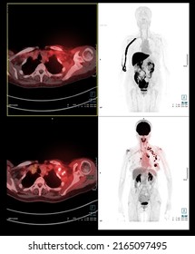 PET Scan Image Of Whole Human Body For Detect Cancer Recurrence After Surgery. Medical Technology Concept.