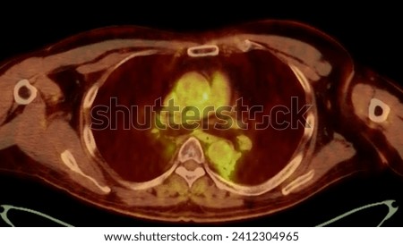 A PET-CT scan image is a diagnostic visualization combining Positron Emission Tomography (PET) and Computed Tomography (CT) for Helps in finding cancer recurrence.