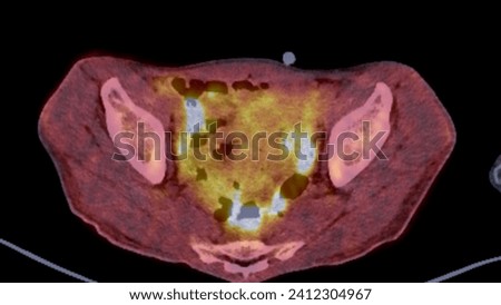 A PET-CT scan image is a diagnostic visualization combining Positron Emission Tomography (PET) and Computed Tomography (CT) for Helps in finding cancer recurrence.