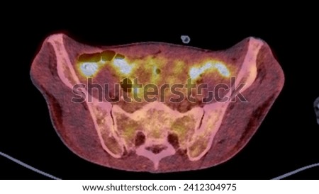 A PET-CT scan image is a diagnostic visualization combining Positron Emission Tomography (PET) and Computed Tomography (CT) for Helps in finding cancer recurrence.