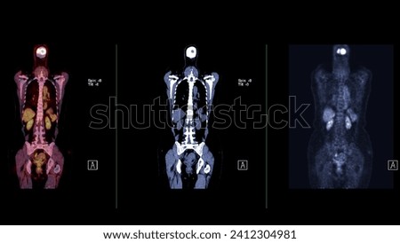 A PET-CT scan image is a diagnostic visualization combining Positron Emission Tomography (PET) and Computed Tomography (CT) for Helps in finding cancer recurrence.