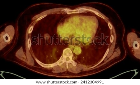 A PET-CT scan image is a diagnostic visualization combining Positron Emission Tomography (PET) and Computed Tomography (CT) for Helps in finding cancer recurrence.