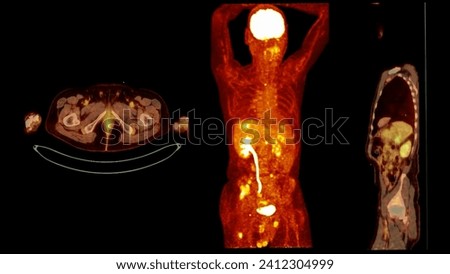 A PET-CT scan image is a diagnostic visualization combining Positron Emission Tomography (PET) and Computed Tomography (CT) for Helps in finding cancer recurrence.
