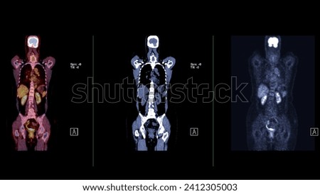 A PET-CT scan image is a diagnostic visualization combining Positron Emission Tomography (PET) and Computed Tomography (CT) for Helps in finding cancer recurrence.