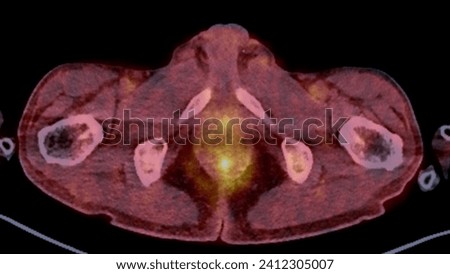 A PET-CT scan image is a diagnostic visualization combining Positron Emission Tomography (PET) and Computed Tomography (CT) for Helps in finding cancer recurrence.