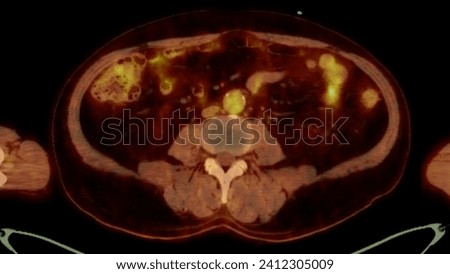 A PET-CT scan image is a diagnostic visualization combining Positron Emission Tomography (PET) and Computed Tomography (CT) for Helps in finding cancer recurrence.