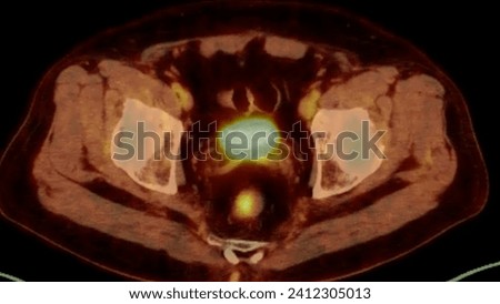 A PET-CT scan image is a diagnostic visualization combining Positron Emission Tomography (PET) and Computed Tomography (CT) for Helps in finding cancer recurrence.