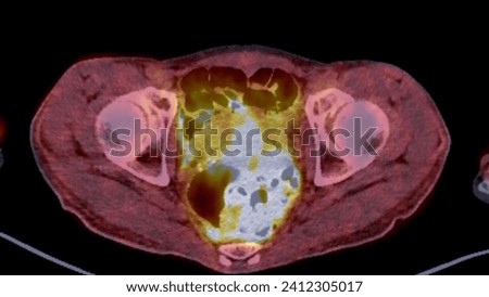 A PET-CT scan image is a diagnostic visualization combining Positron Emission Tomography (PET) and Computed Tomography (CT) for Helps in finding cancer recurrence.