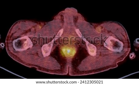 A PET-CT scan image is a diagnostic visualization combining Positron Emission Tomography (PET) and Computed Tomography (CT) for Helps in finding cancer recurrence.