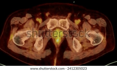 A PET-CT scan image is a diagnostic visualization combining Positron Emission Tomography (PET) and Computed Tomography (CT) for Helps in finding cancer recurrence.