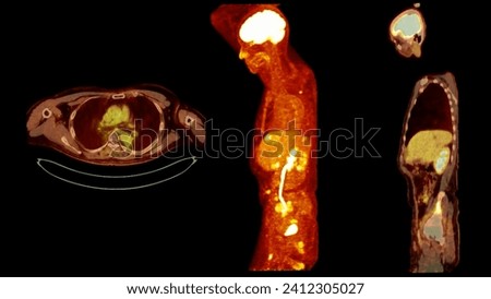 A PET-CT scan image is a diagnostic visualization combining Positron Emission Tomography (PET) and Computed Tomography (CT) for Helps in finding cancer recurrence.