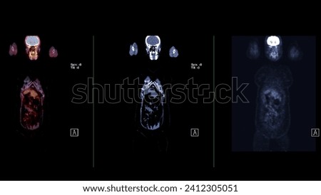 A PET-CT scan image is a diagnostic visualization combining Positron Emission Tomography (PET) and Computed Tomography (CT) for Helps in finding cancer recurrence.