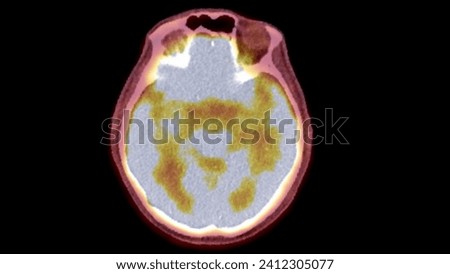 A PET-CT scan image is a diagnostic visualization combining Positron Emission Tomography (PET) and Computed Tomography (CT) for Helps in finding cancer recurrence.