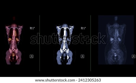 A PET-CT scan image is a diagnostic visualization combining Positron Emission Tomography (PET) and Computed Tomography (CT) for Helps in finding cancer recurrence.