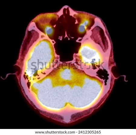 A PET-CT scan image is a diagnostic visualization combining Positron Emission Tomography (PET) and Computed Tomography (CT) for Helps in finding cancer recurrence.