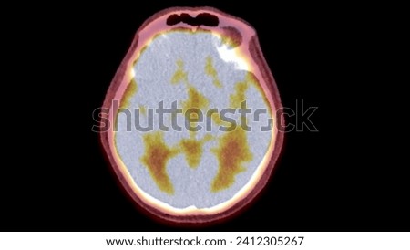 A PET-CT scan image is a diagnostic visualization combining Positron Emission Tomography (PET) and Computed Tomography (CT) for Helps in finding cancer recurrence.