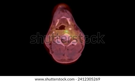 A PET-CT scan image is a diagnostic visualization combining Positron Emission Tomography (PET) and Computed Tomography (CT) for Helps in finding cancer recurrence.