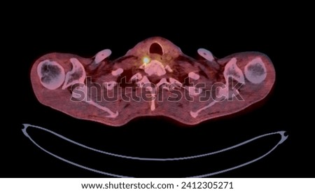 A PET-CT scan image is a diagnostic visualization combining Positron Emission Tomography (PET) and Computed Tomography (CT) for Helps in finding cancer recurrence.