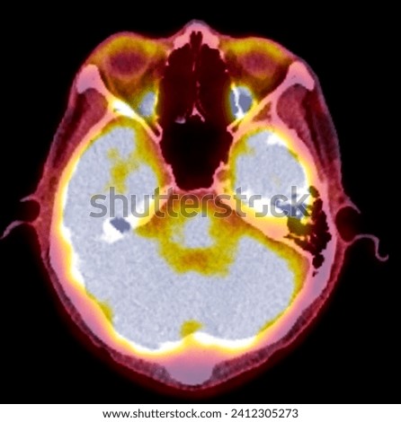 A PET-CT scan image is a diagnostic visualization combining Positron Emission Tomography (PET) and Computed Tomography (CT) for Helps in finding cancer recurrence.