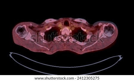 A PET-CT scan image is a diagnostic visualization combining Positron Emission Tomography (PET) and Computed Tomography (CT) for Helps in finding cancer recurrence.