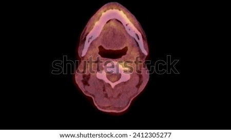 A PET-CT scan image is a diagnostic visualization combining Positron Emission Tomography (PET) and Computed Tomography (CT) for Helps in finding cancer recurrence.