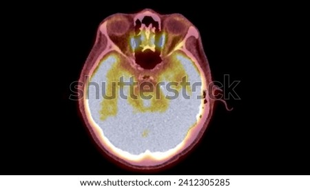 A PET-CT scan image is a diagnostic visualization combining Positron Emission Tomography (PET) and Computed Tomography (CT) for Helps in finding cancer recurrence.