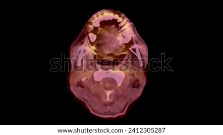 A PET-CT scan image is a diagnostic visualization combining Positron Emission Tomography (PET) and Computed Tomography (CT) for Helps in finding cancer recurrence.