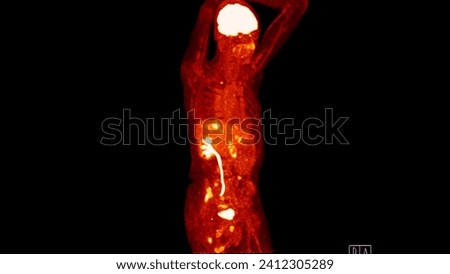 A PET-CT scan image is a diagnostic visualization combining Positron Emission Tomography (PET) and Computed Tomography (CT) for Helps in finding cancer recurrence.