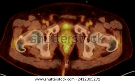 A PET-CT scan image is a diagnostic visualization combining Positron Emission Tomography (PET) and Computed Tomography (CT) for Helps in finding cancer recurrence.