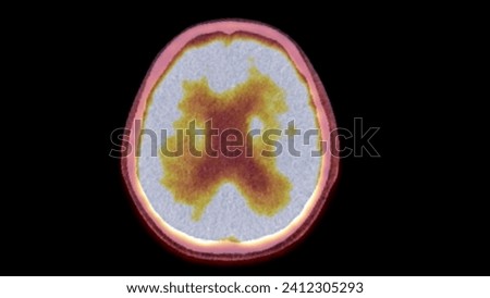 A PET-CT scan image is a diagnostic visualization combining Positron Emission Tomography (PET) and Computed Tomography (CT) for Helps in finding cancer recurrence.