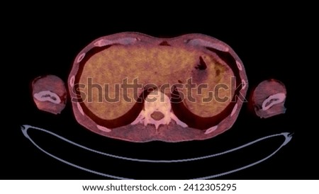 A PET-CT scan image is a diagnostic visualization combining Positron Emission Tomography (PET) and Computed Tomography (CT) for Helps in finding cancer recurrence.