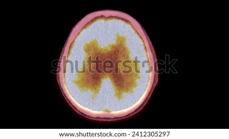 A PET-CT scan image is a diagnostic visualization combining Positron Emission Tomography (PET) and Computed Tomography (CT) for Helps in finding cancer recurrence.